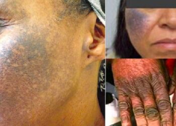 Skin Bleaching in Nigeria: Doctors Warn of Hidden Dangers and Lifelong Damage